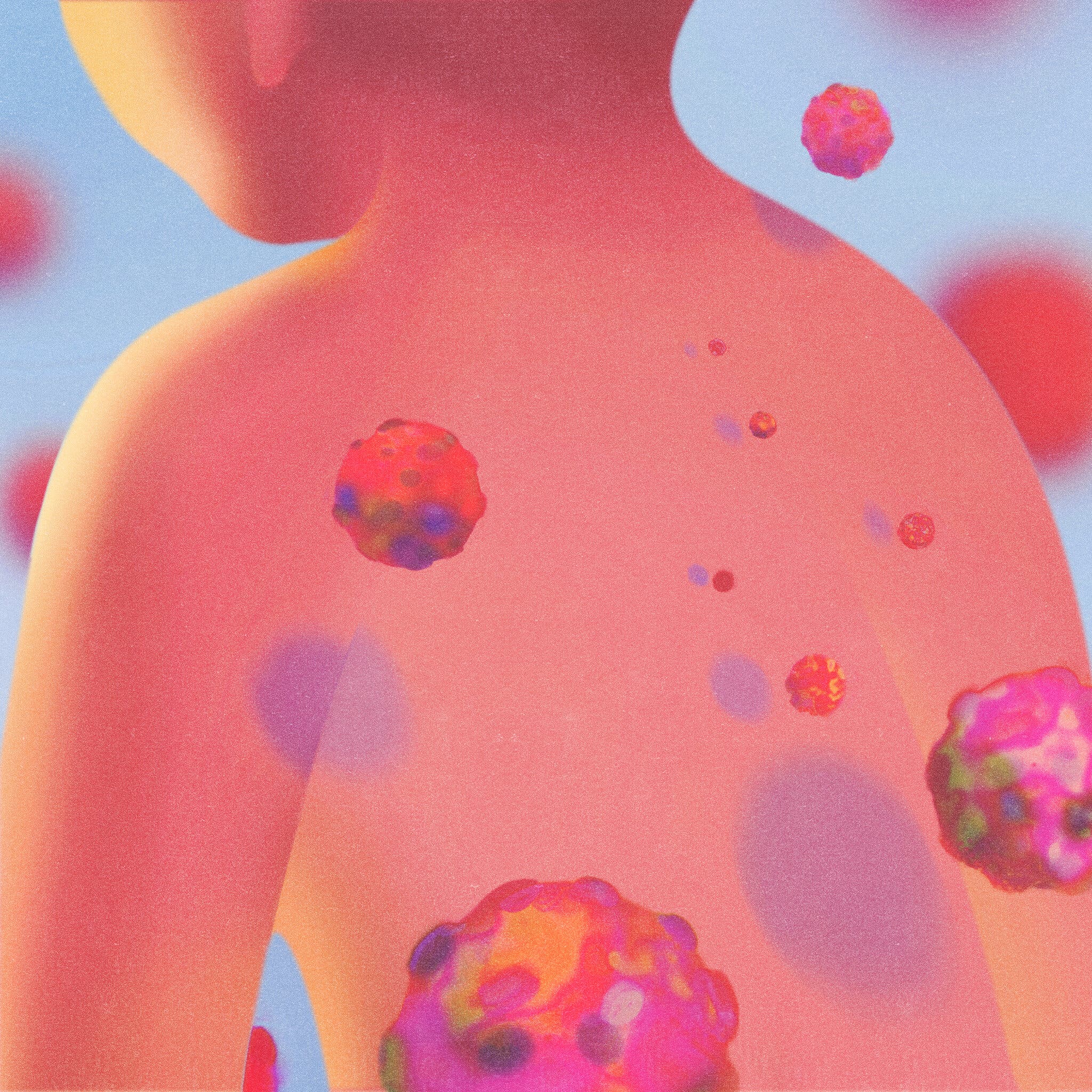 Increased Measles Cases Spur US Vaccine Monitoring Initiative Increased Measles Cases Spur US Vaccine Monitoring Initiative