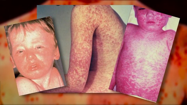 Kansas Reports Six Additional Measles Cases: Health Officials Urge Vaccination Kansas Reports Six Additional Measles Cases: Health Officials Urge Vaccination