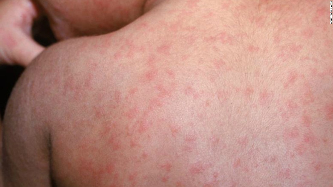 Measles In Kansas: Causes, Prevention, And Current Situation Measles In Kansas: Causes, Prevention, And Current Situation