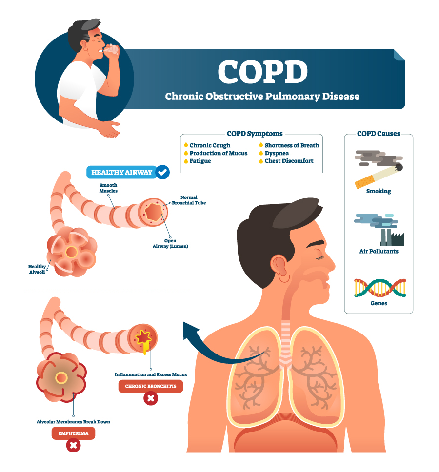 New Data Highlights Sanofi's Progress In Asthma And COPD Treatment New Data Highlights Sanofi's Progress In Asthma And COPD Treatment