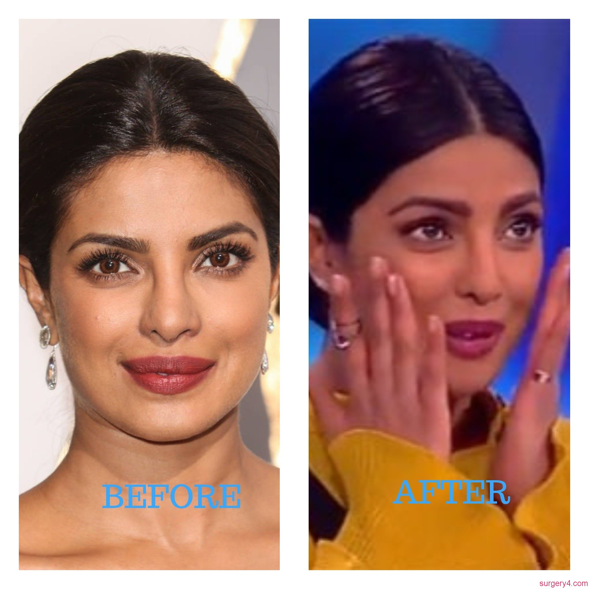 Priyanka Chopra's Nose Job: Her Father's Response Priyanka Chopra's Nose Job: Her Father's Response