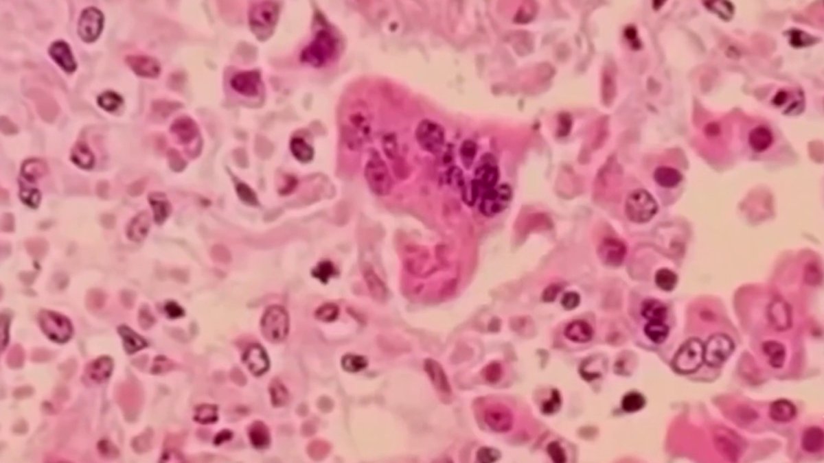 Sacramento County Public Health Responds To Measles Detection In Wastewater Sacramento County Public Health Responds To Measles Detection In Wastewater