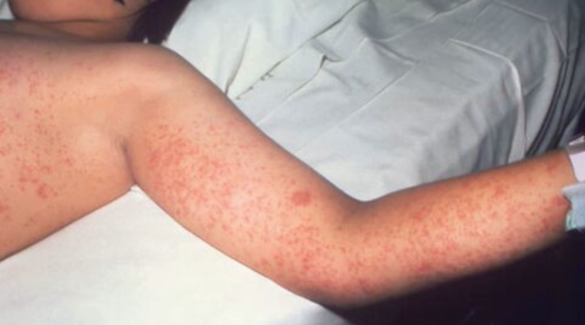 Texas Measles: New Clusters Emerge Beyond Initial Outbreak Texas Measles: New Clusters Emerge Beyond Initial Outbreak