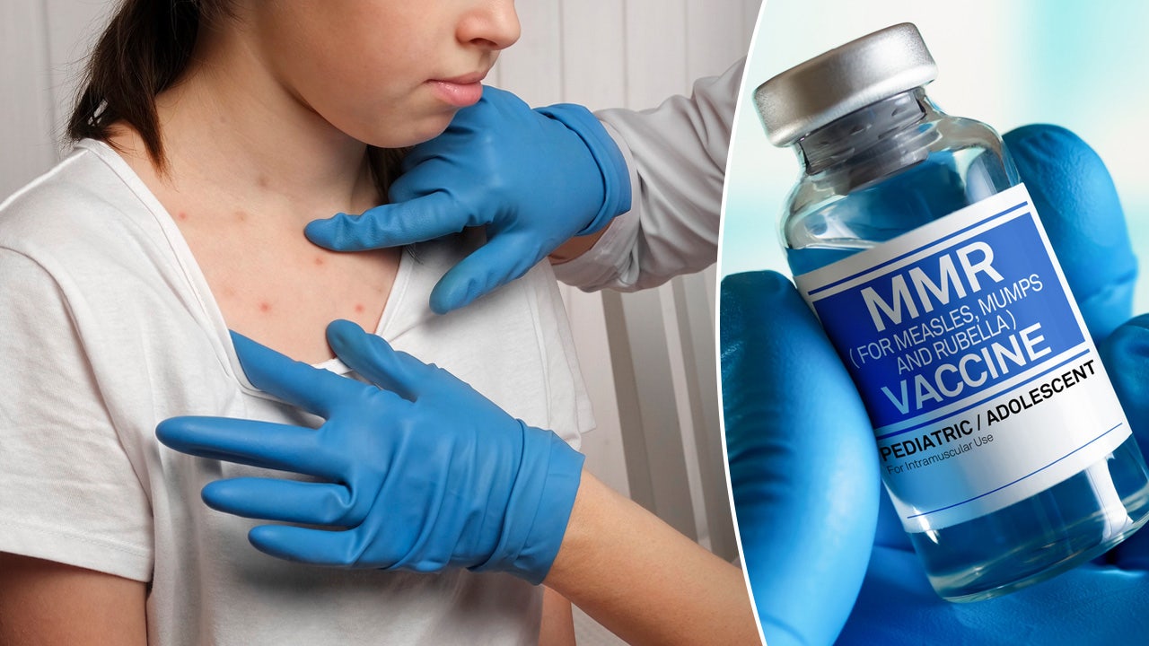 Virginia Reports Second Measles Case In 2025: Health Officials Investigate Virginia Reports Second Measles Case In 2025: Health Officials Investigate